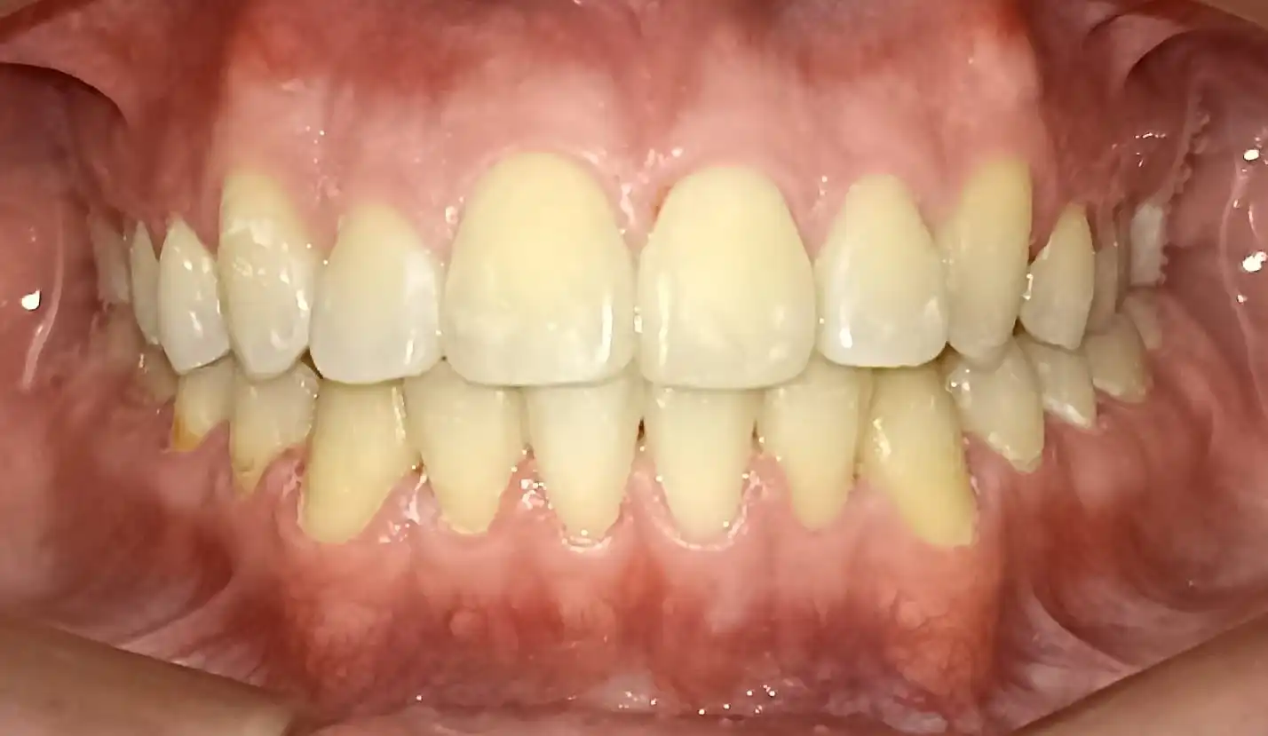 Después del tratamiento de Sabino